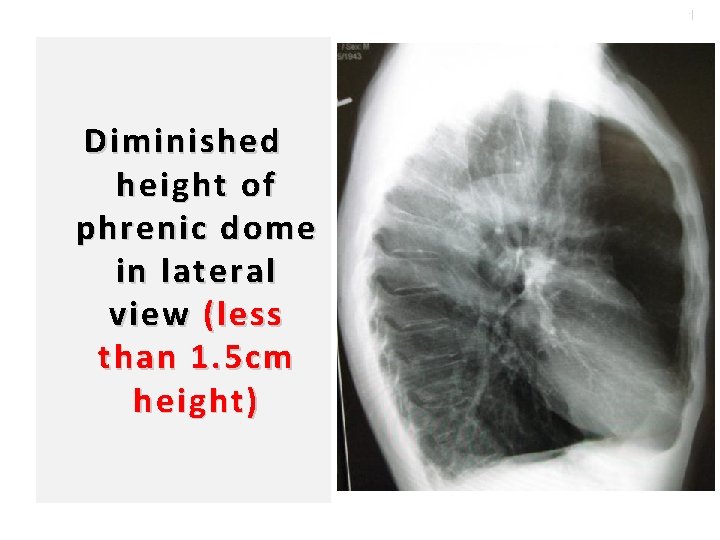 101 Diminished height of phrenic dome in lateral view (less than 1. 5 cm
