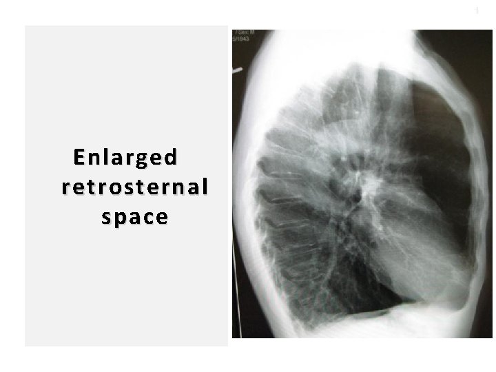 102 Enlarged retrosternal space 