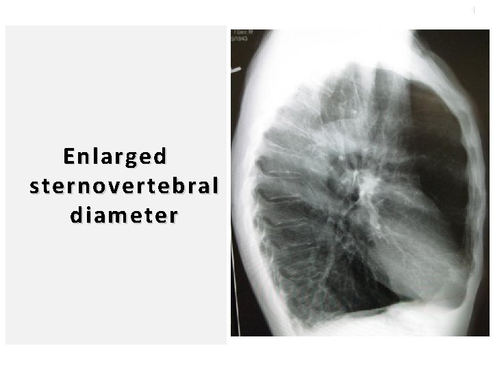103 Enlarged sternovertebral diameter 