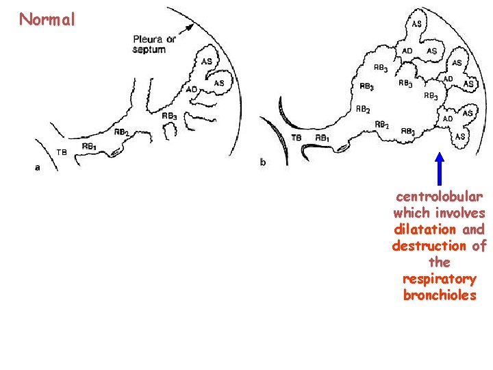 Normal 106 centrolobular which involves dilatation and destruction of the respiratory bronchioles 