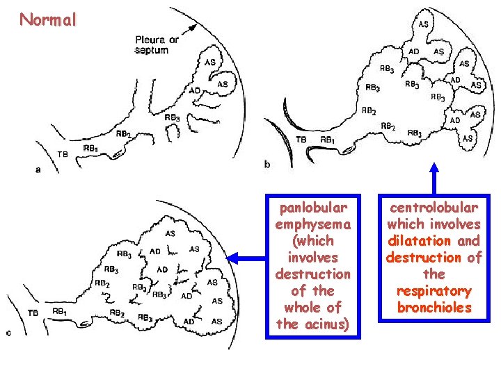 Normal 107 panlobular emphysema (which involves destruction of the whole of the acinus) centrolobular