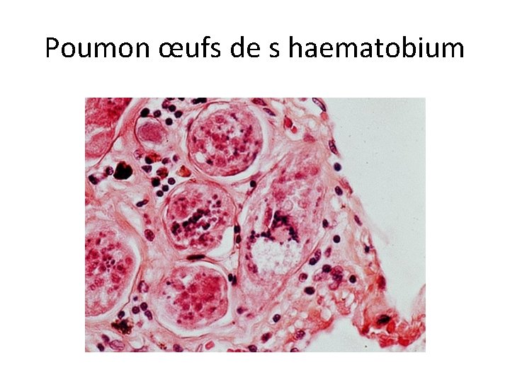 Poumon œufs de s haematobium 