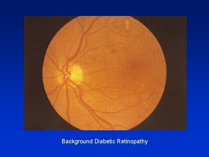 Background Diabetic Retinopathy 