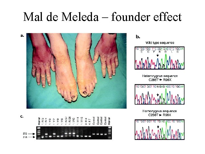 Mal de Meleda – founder effect 