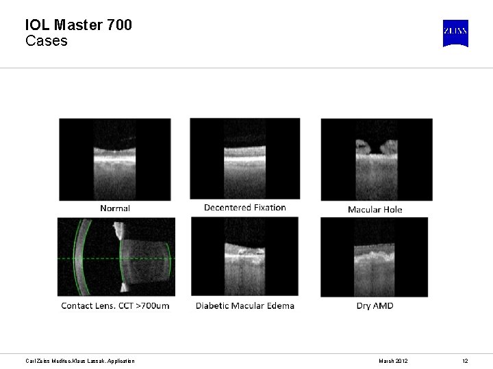 IOL Master 700 Cases Carl Zeiss Meditec, Klaus Lassak, Application March 2012 12 