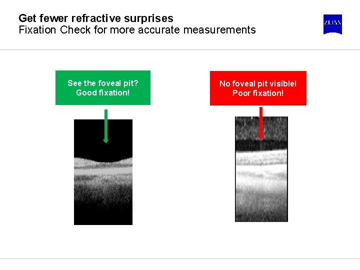 Get fewer refractive surprises Fixation Check for more accurate measurements See the foveal pit?