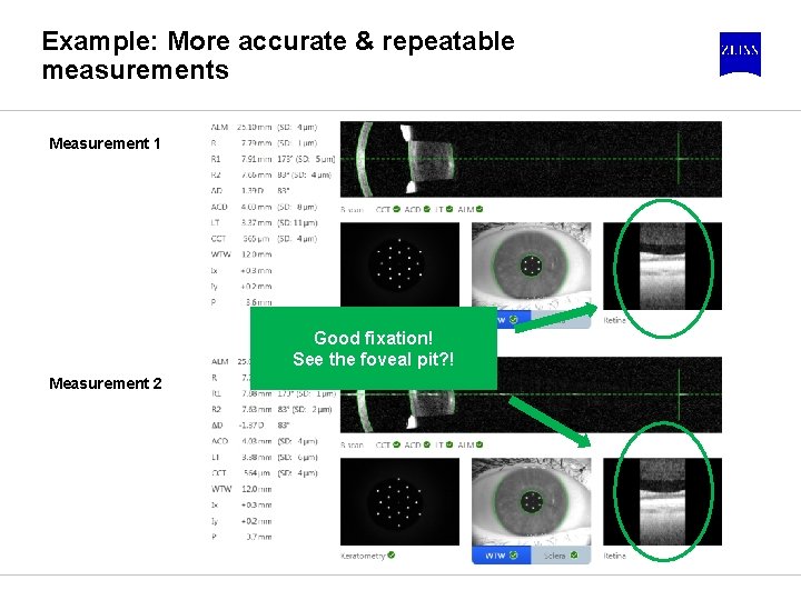 Example: More accurate & repeatable measurements Measurement 1 Good fixation! See the foveal pit?