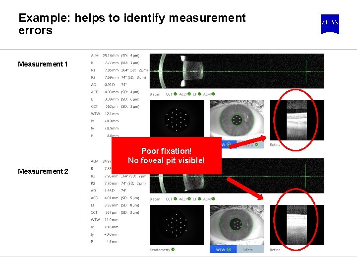 Example: helps to identify measurement errors Measurement 1 Poor fixation! No foveal pit visible!