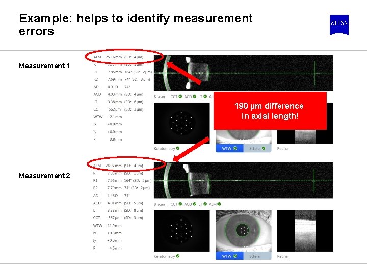 Example: helps to identify measurement errors Measurement 1 190 µm difference in axial length!