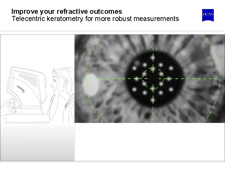 Improve your refractive outcomes Telecentric keratometry for more robust measurements 