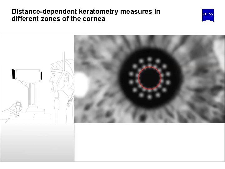 Distance-dependent keratometry measures in different zones of the cornea 