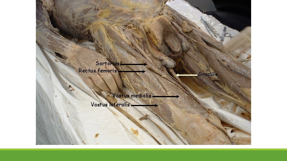 Sartorius Rectus femoris Vastus medialis Vastus lateralis Gracilis 