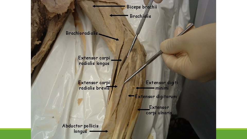 Biceps brachii Brachialis Brachioradialis Extensor carpi radialis longus Extensor carpi radialis brevis Extensor digiti