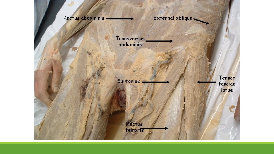 Rectus abdominis External oblique Transversus abdominis Sartorius Rectus femoris Tensor fasciae latae 