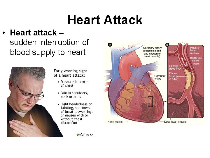 Heart Attack • Heart attack – sudden interruption of blood supply to heart 