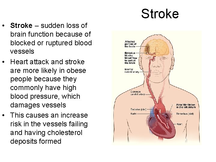 Stroke • Stroke – sudden loss of brain function because of blocked or ruptured