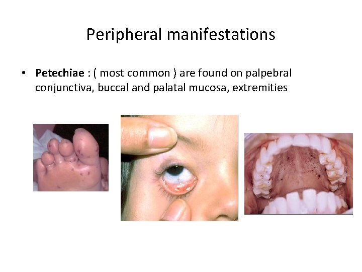 Peripheral manifestations • Petechiae : ( most common ) are found on palpebral conjunctiva,