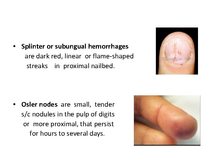  • Splinter or subungual hemorrhages are dark red, linear or flame-shaped streaks in