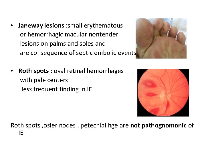  • Janeway lesions : small erythematous or hemorrhagic macular nontender lesions on palms