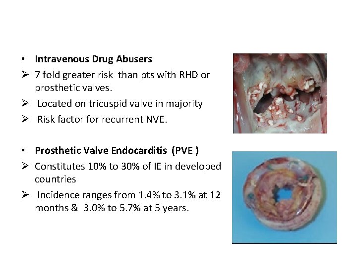  • Intravenous Drug Abusers Ø 7 fold greater risk than pts with RHD