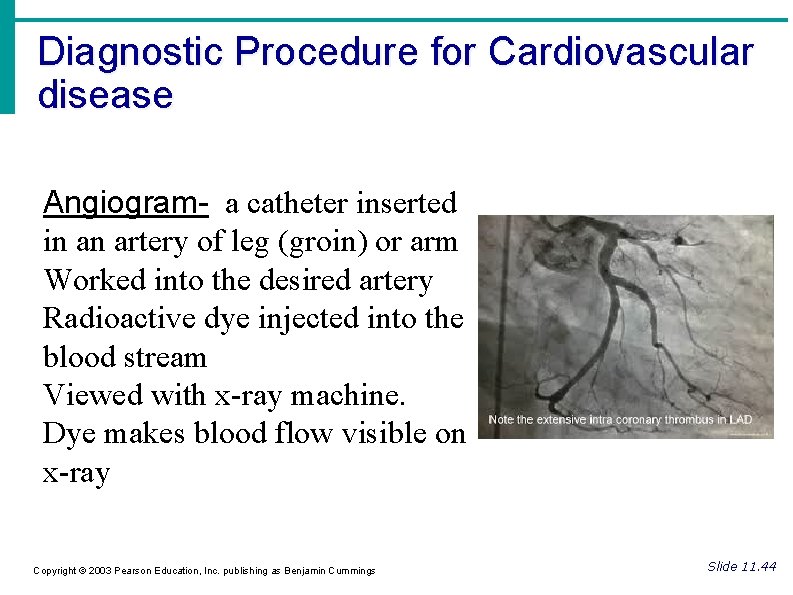 Diagnostic Procedure for Cardiovascular disease Angiogram- a catheter inserted in an artery of leg