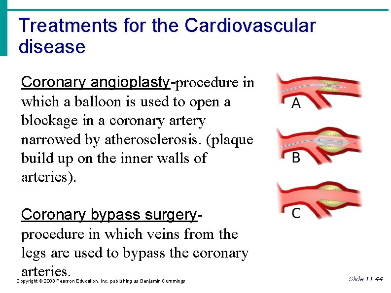 Treatments for the Cardiovascular disease Coronary angioplasty-procedure in which a balloon is used to