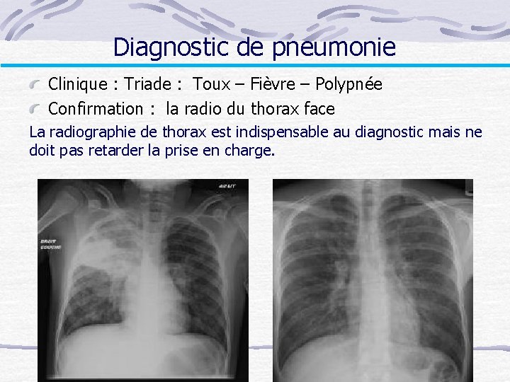 Diagnostic de pneumonie Clinique : Triade : Toux – Fièvre – Polypnée Confirmation :