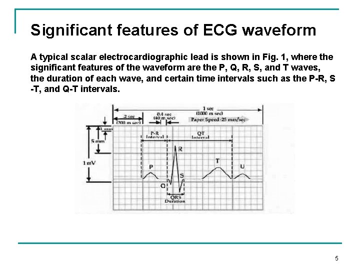 Significant features of ECG waveform A typical scalar electrocardiographic lead is shown in Fig.