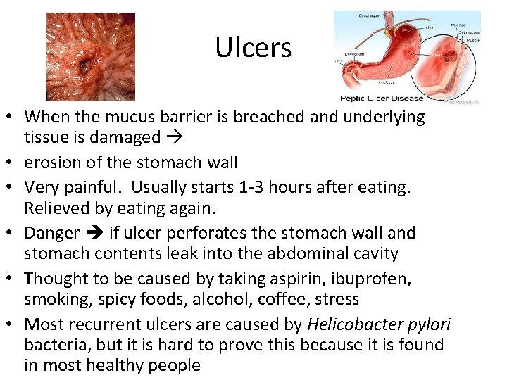 Ulcers • When the mucus barrier is breached and underlying tissue is damaged •