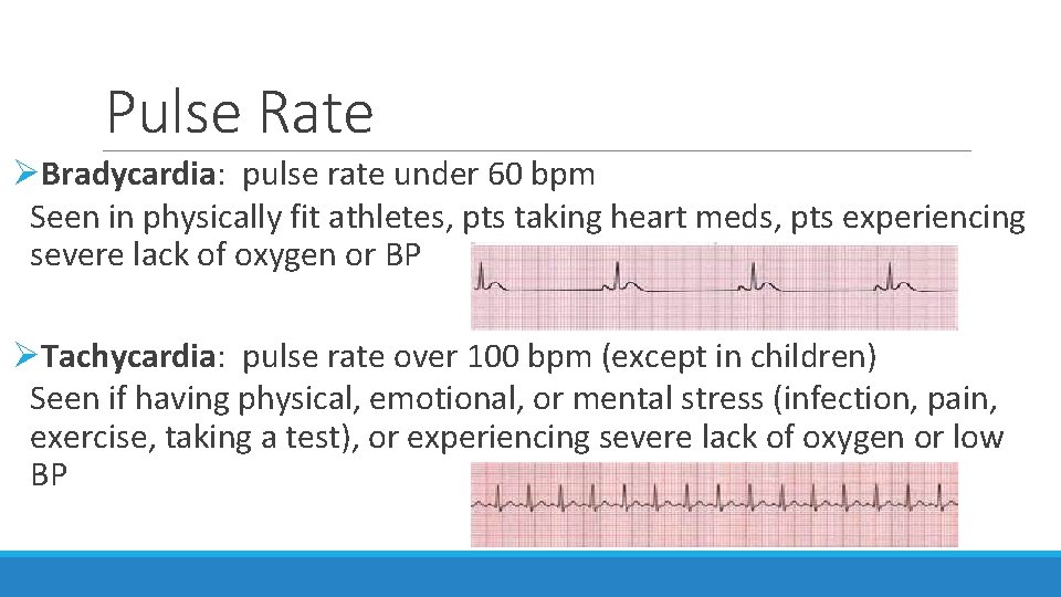 Pulse Rate ØBradycardia: pulse rate under 60 bpm Seen in physically fit athletes, pts