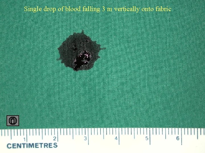 Single drop of blood falling 3 m vertically onto fabric 3 fabric 