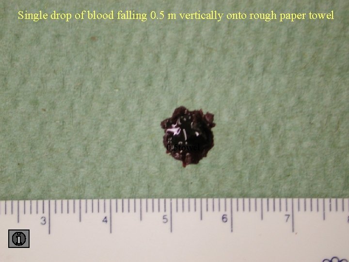 Single drop of blood falling 0. 5 m vertically onto rough paper towel 0.