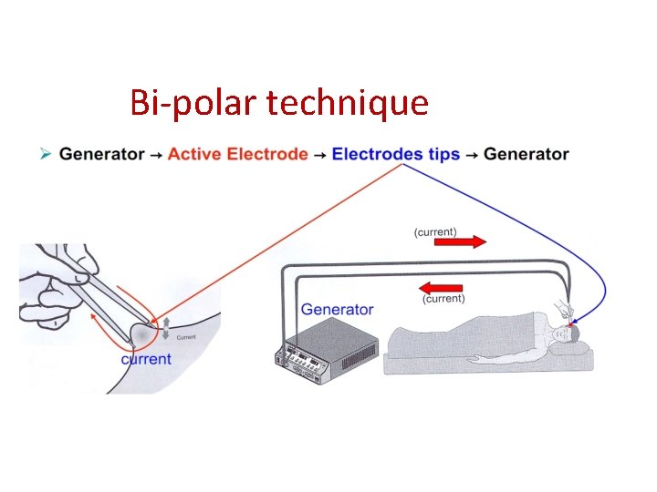 Bi-polar technique 