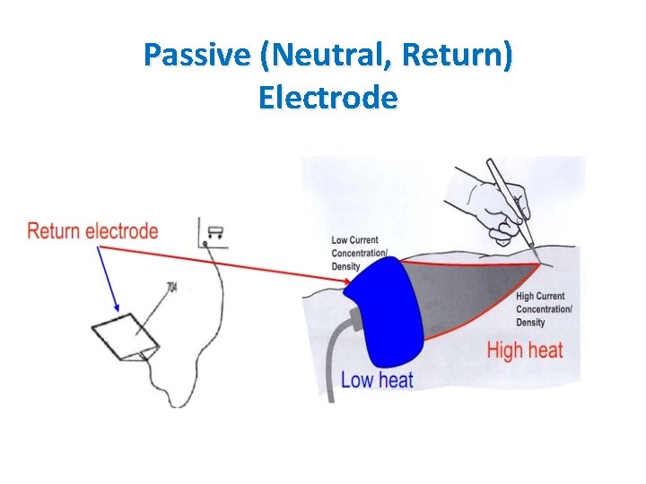 Passive (Neutral, Return) Electrode 