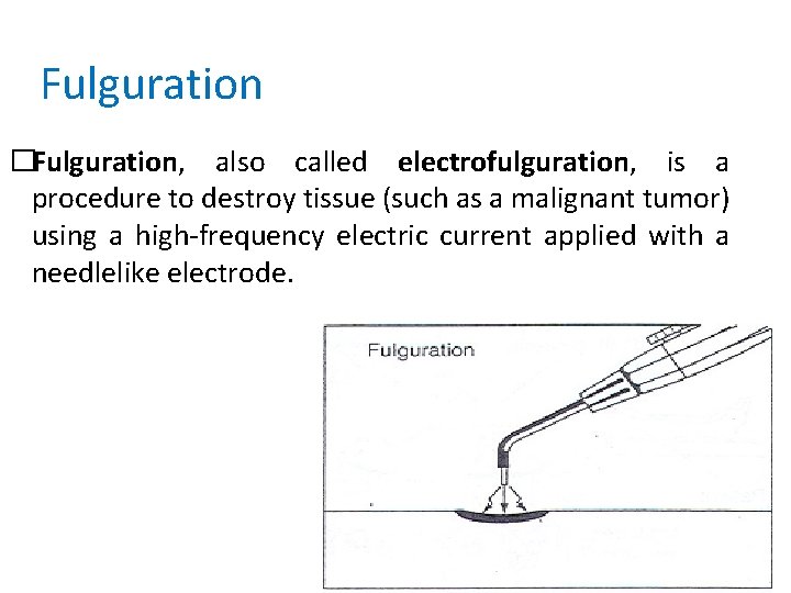 Fulguration �Fulguration, also called electrofulguration, is a procedure to destroy tissue (such as a
