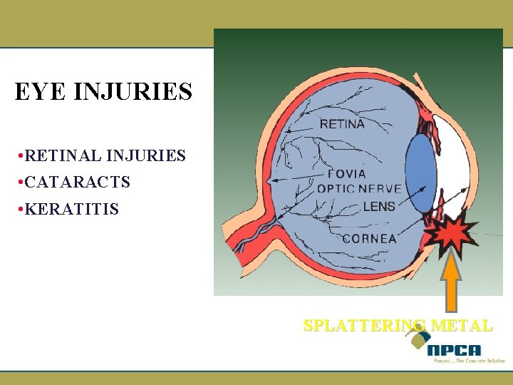 EYE INJURIES • RETINAL INJURIES • CATARACTS • KERATITIS SPLATTERING METAL 