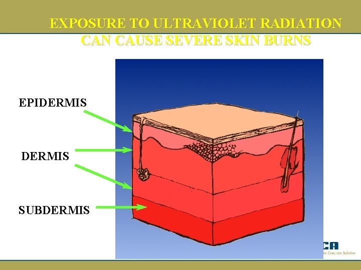 EXPOSURE TO ULTRAVIOLET RADIATION CAUSE SEVERE SKIN BURNS EPIDERMIS SUBDERMIS 