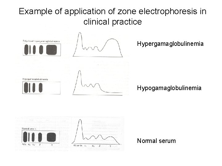 Example of application of zone electrophoresis in clinical practice Hypergamaglobulinemia Hypogamaglobulinemia Normal serum 