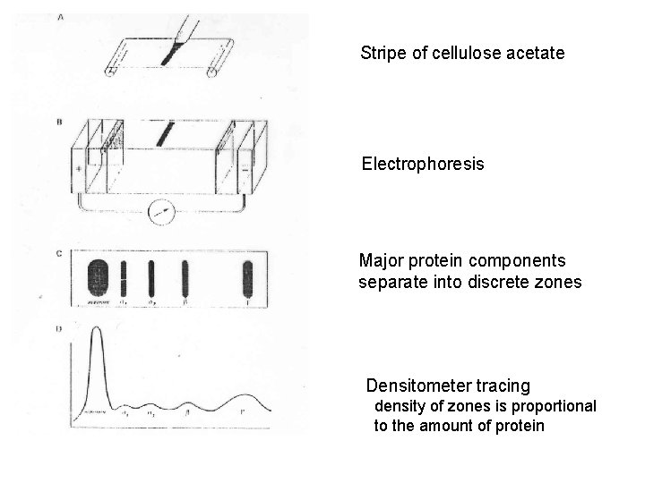 Stripe of cellulose acetate Electrophoresis Major protein components separate into discrete zones Densitometer tracing