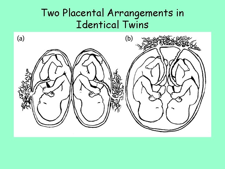 Two Placental Arrangements in Identical Twins 