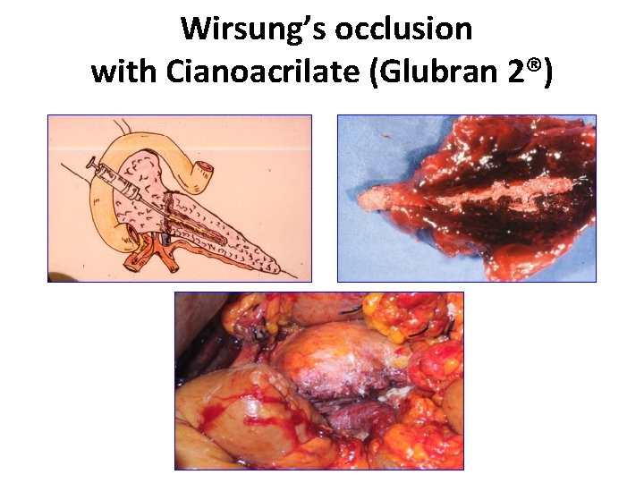 Wirsung’s occlusion with Cianoacrilate (Glubran 2®) 