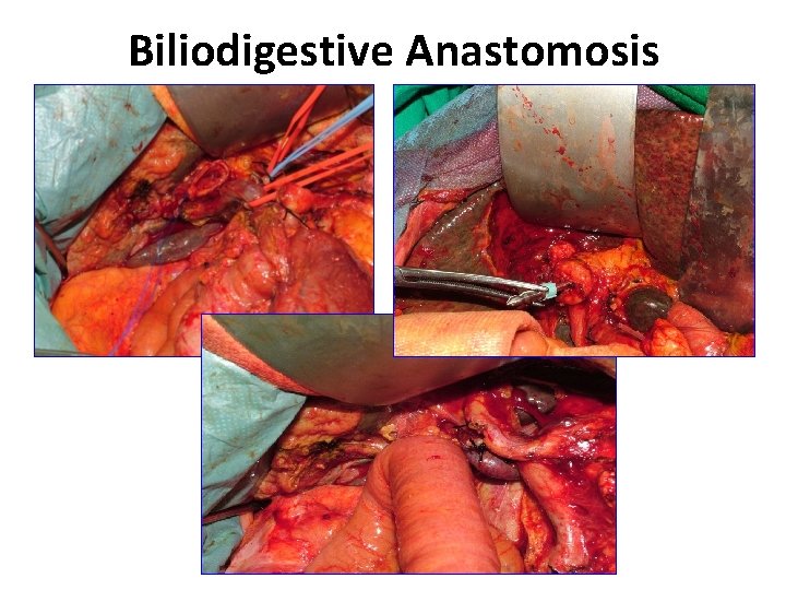 Biliodigestive Anastomosis 