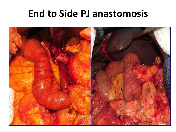 End to Side PJ anastomosis 