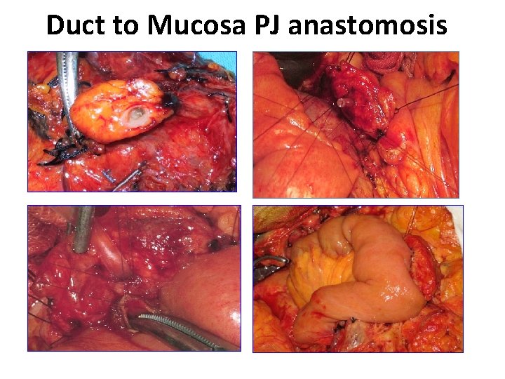 Duct to Mucosa PJ anastomosis 