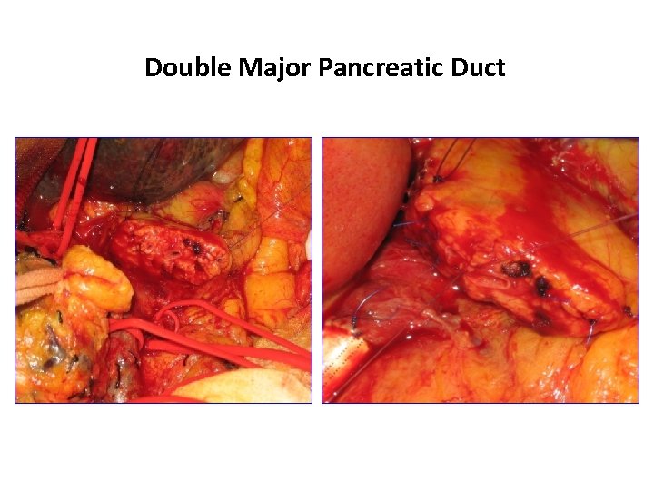 Double Major Pancreatic Duct 