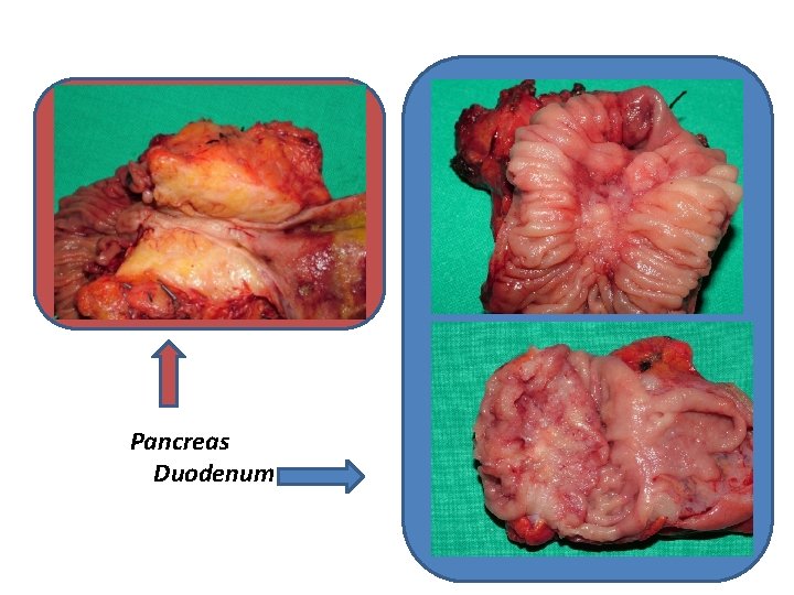 Pancreas Duodenum 