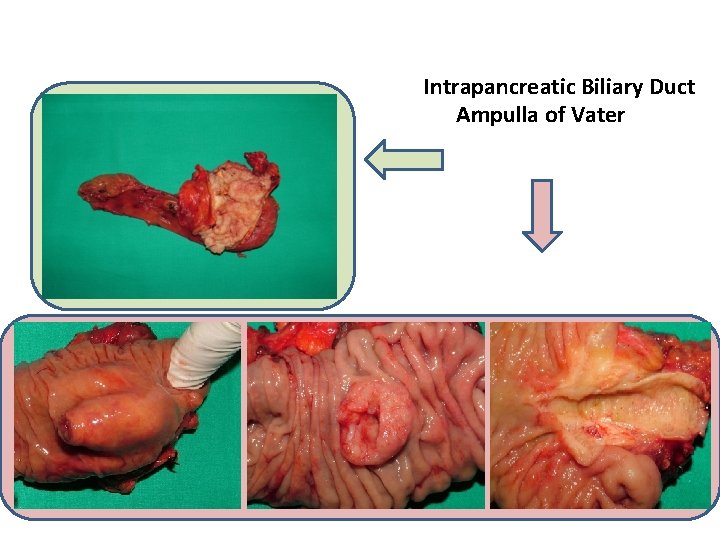 Intrapancreatic Biliary Duct Ampulla of Vater 