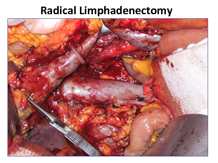 Radical Limphadenectomy 