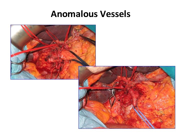 Anomalous Vessels 