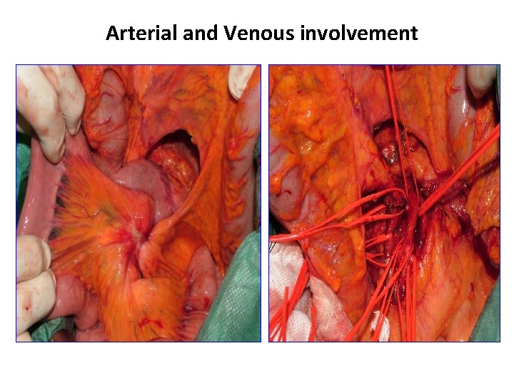 Arterial and Venous involvement 